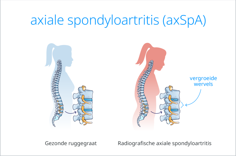 Wat zijn axiale spondyloartritis en de meer gevorderde vorm ervan de ziekte van Bechterew